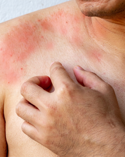 allergy testing allergy testing center