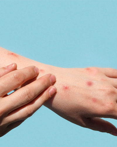 allergy testing allergy testing clinic