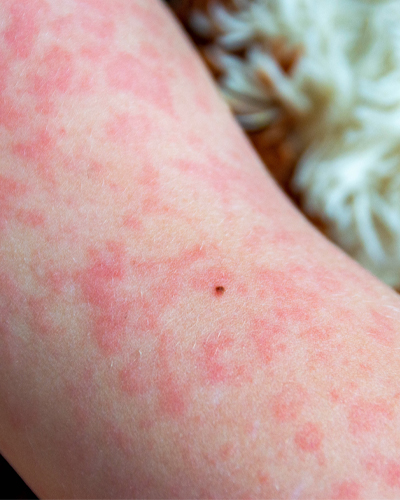 allergy testing center near me Allergy Solutions near me