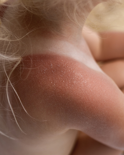 allergy testing center allergy testing