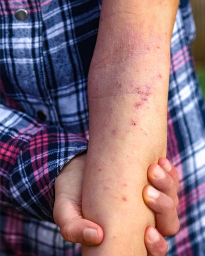 llergy testing clinic allergy testing center